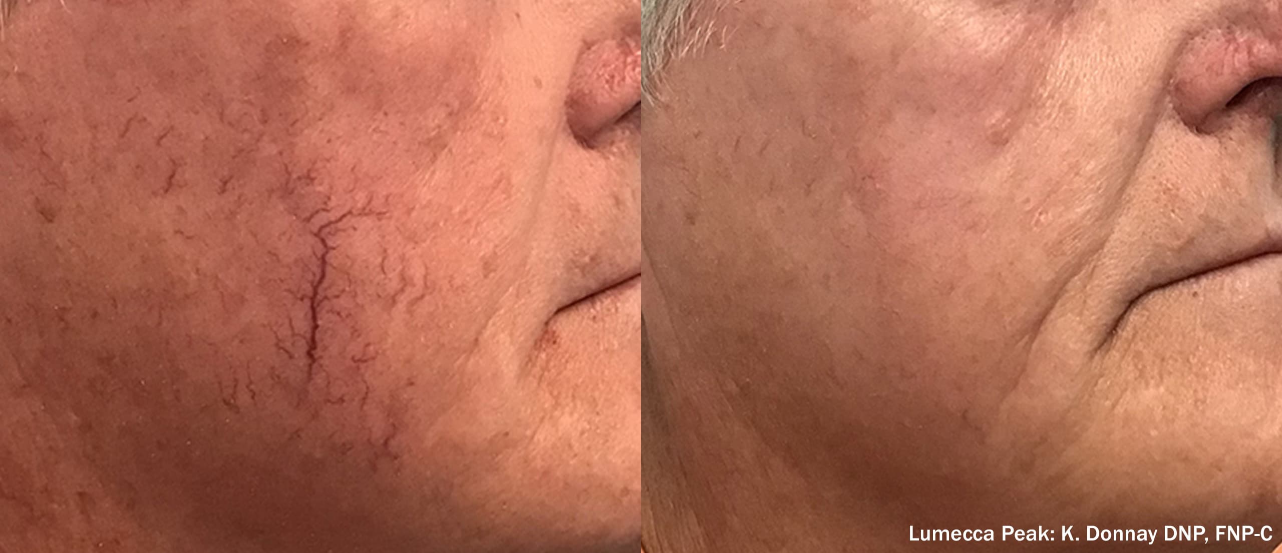 Inmode Lumecca Peak Image 1