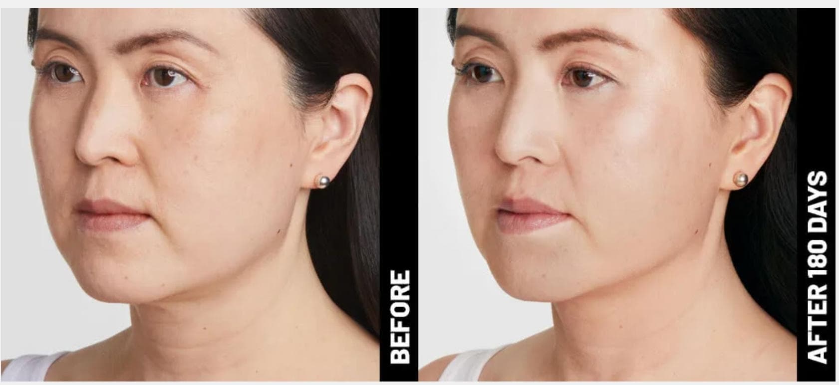 Ultherapy® Prime Image 3