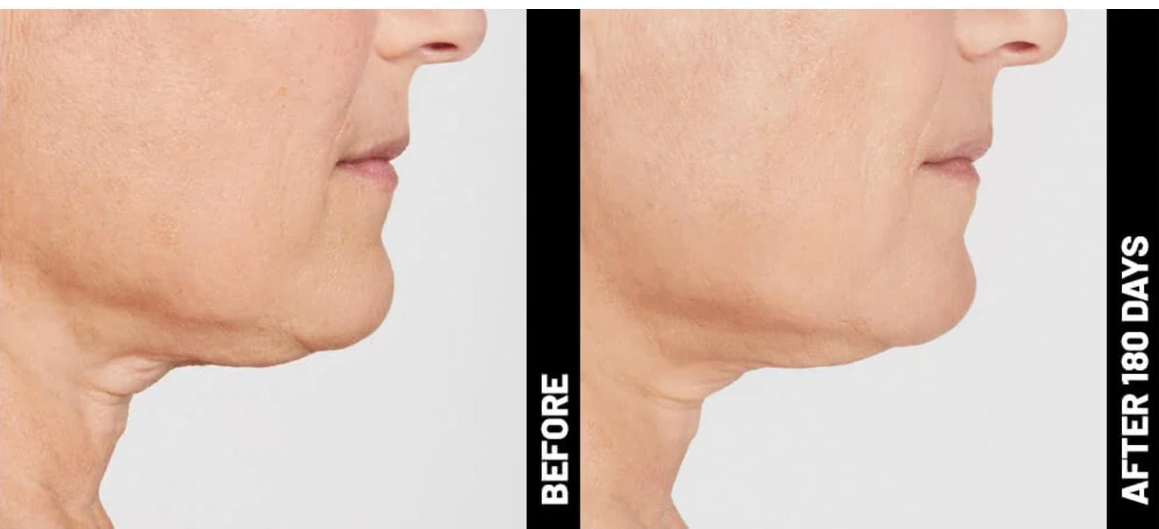 Ultherapy® Prime Image 4